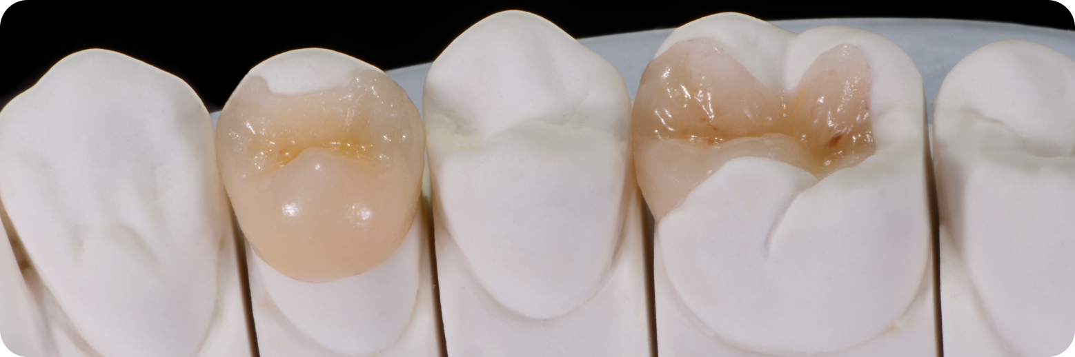  Cabinet dentaire santy traitement inlay onlay overlay